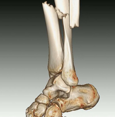 博为医学影像三维重建推动张家口市第二医院发